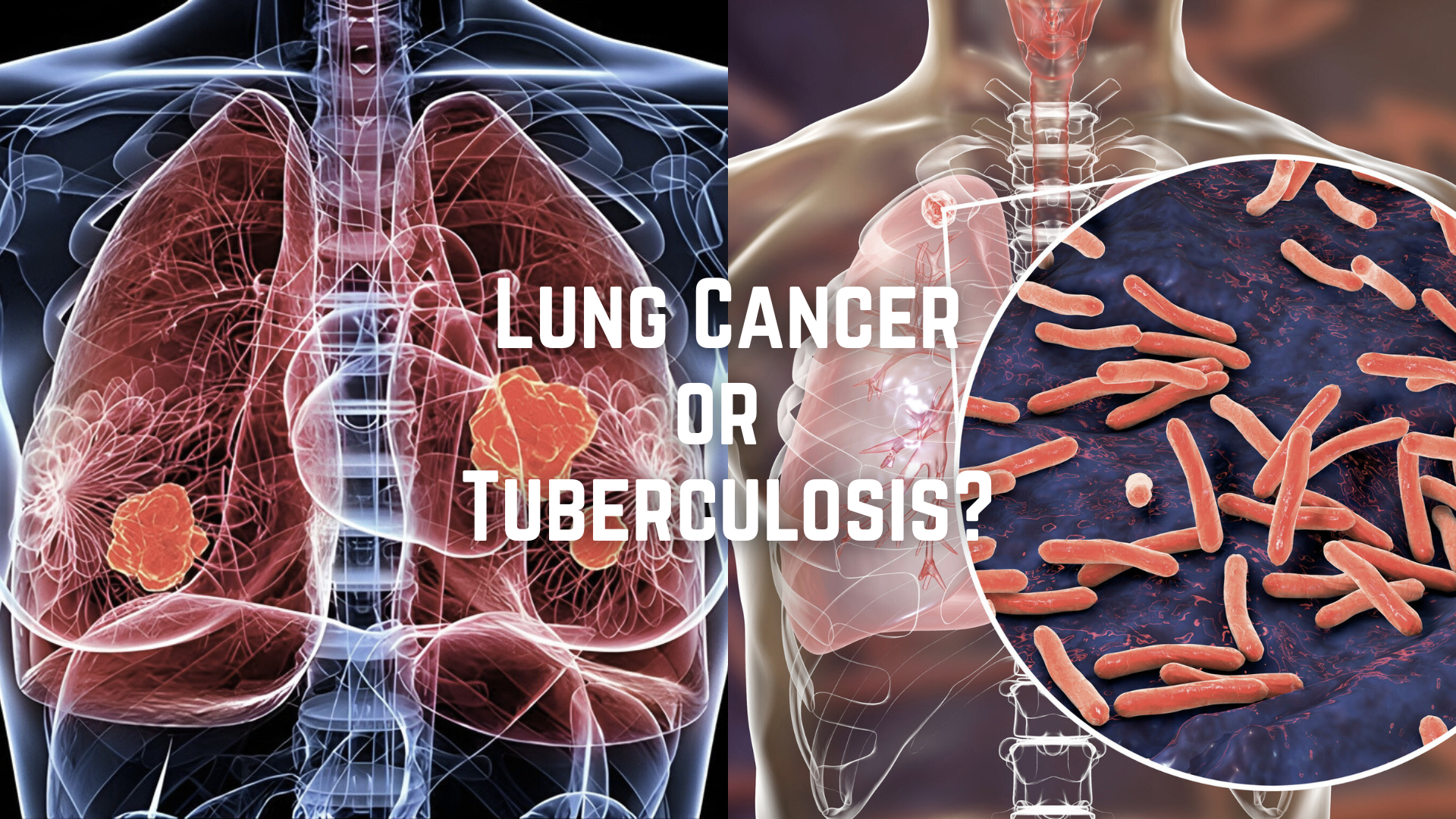 Ketika Tuberkulosis “Menyamar” sebagai Kanker Paru: Mengapa Salah Diagnosis Bisa Terjadi dan Bagaimana Genomik Membantu Menjawabnya