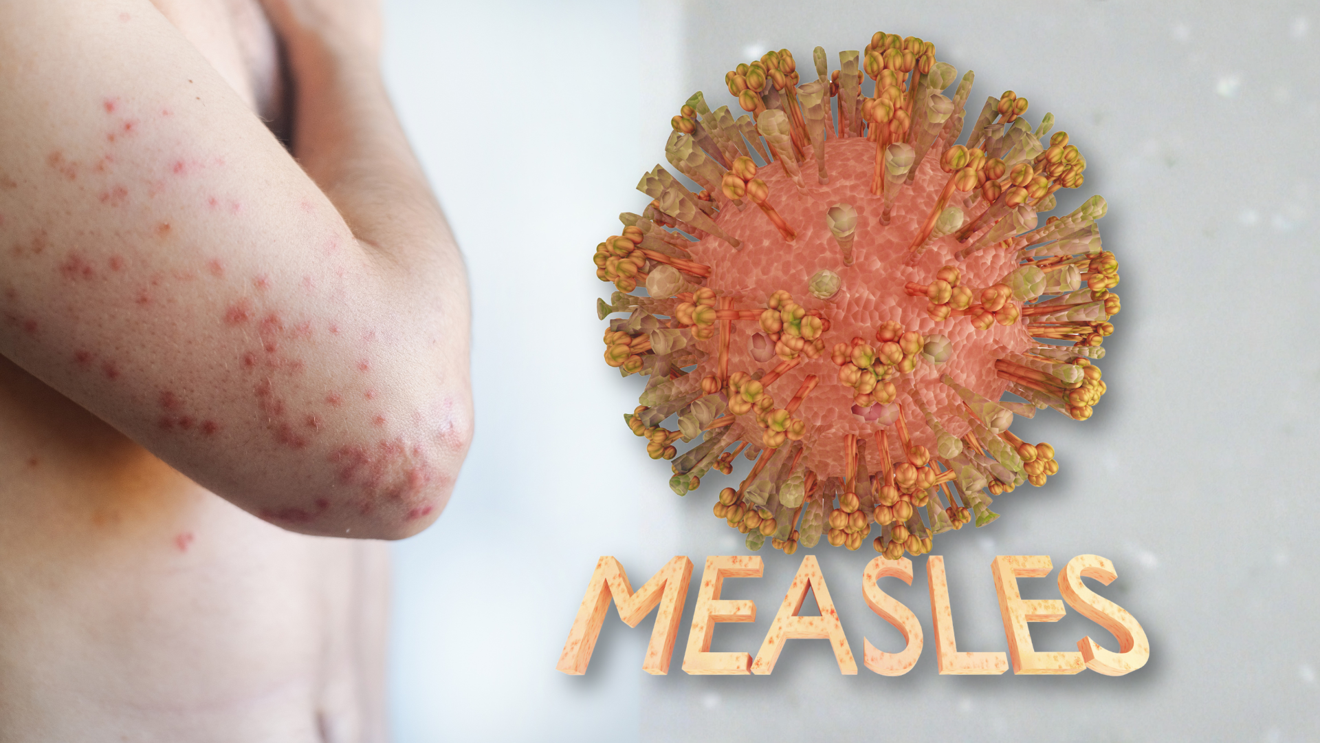 Update Kasus Campak di Indonesia Awal 2026: Mengapa Kembali Meningkat?